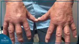 Arthritis Pain Left Me Immobile, But Traditional Therapy Restored My Strength and Energy