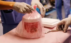 Transplanted pig kidney works in US man’s body for record 271 days