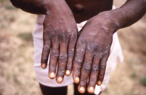 Kenya to receive mpox vaccines from stockpile